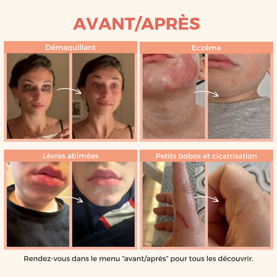 Avant/Après : Démaquillant, Eczéma, Lèvres abîmées, Petits bobos et cicatrisation. Quatre comparaisons visuelles illustrant les effets du Baume Magique Les Petits Prödiges sur différentes conditions de peau avant et après utilisation.
